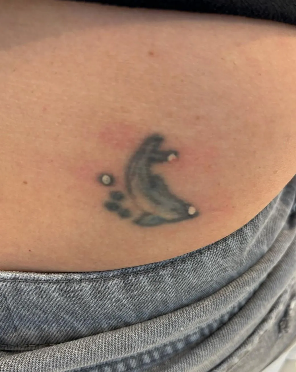 Laser tattoo removal