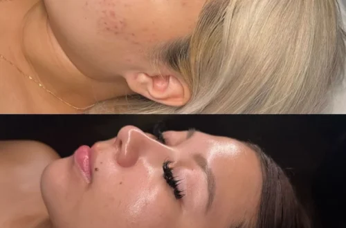 When should you start getting facials