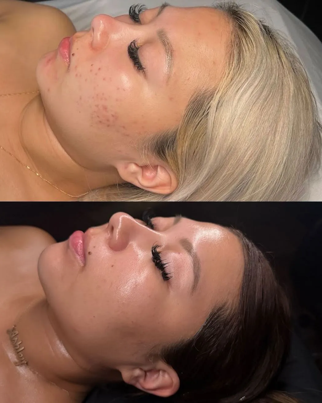 When should you start getting facials